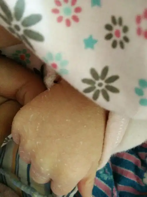我家宝宝除了脸上不掉皮,身上都掉皮,这正常吗?