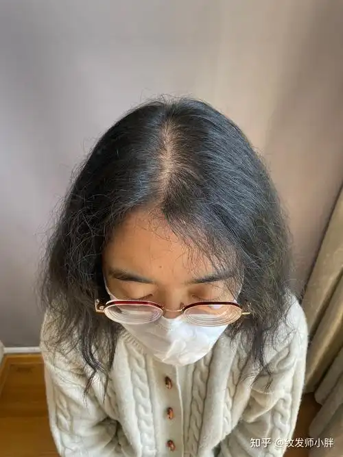 女性脱发怎么办