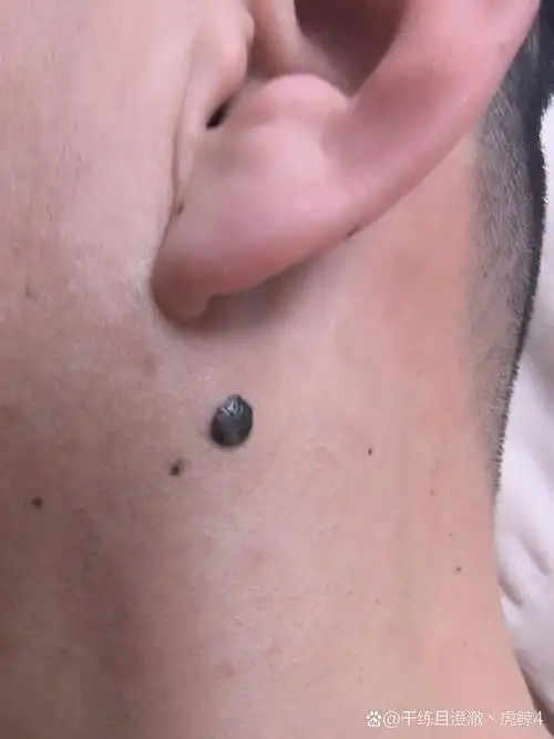 耳朵后面长痣好不好