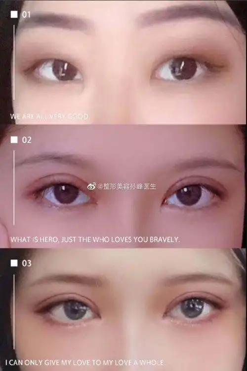 虽然恢复期间存在些许肿胀的情况,但是恢复之后双眼皮不管是自然度