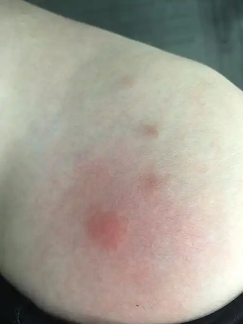 这是被跳蚤咬去的吗,抓过就会很痒