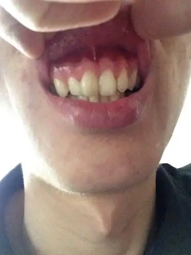 问:上颚骨凸出,牙床凸出,大概是从两三年前开始的,以前并不明显,我