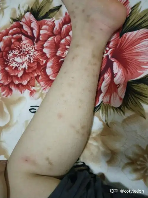 被跳蚤咬的全身都是包是什么样的感受! - 知乎