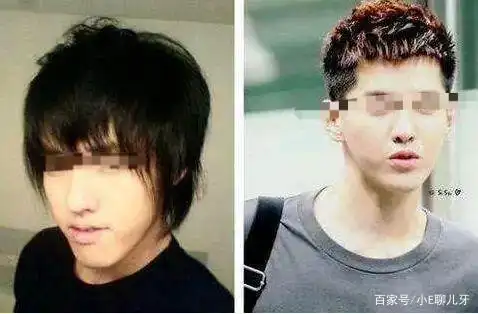 吴亦凡的牙也不本分,曾是地包天,如今成露龈笑,他经历了什么?