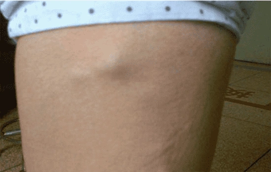 抽脂后遗症图片 看到最后表示再也不敢抽脂了