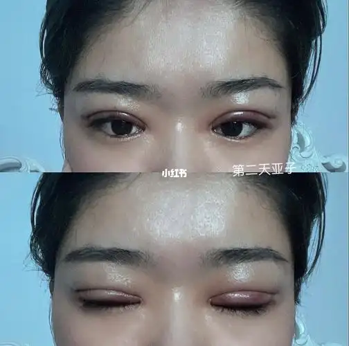 双眼皮(埋线)最后一张第三天_双眼皮_美妆_医美整形