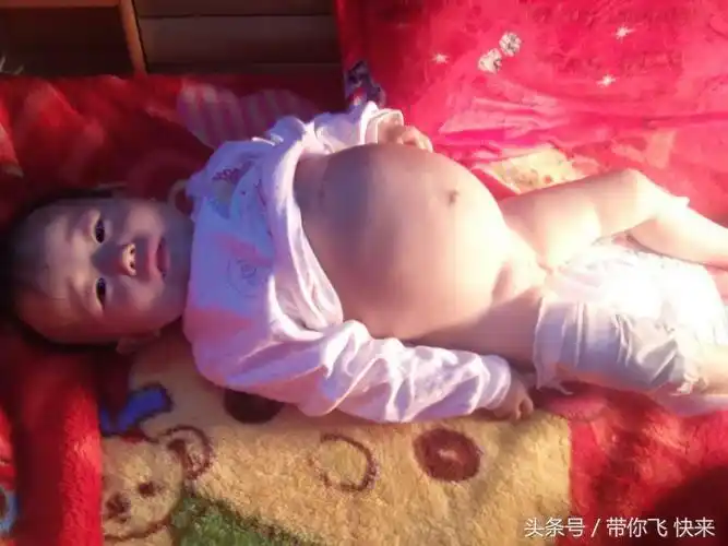 2岁小女孩生怪病肚子大如气球差点死掉