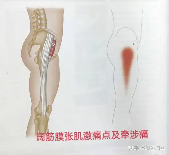 臀部与大腿外侧疼痛相关激痛点及穴位