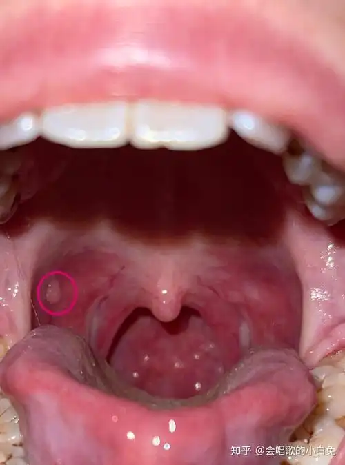 口腔里长了一个肉疙瘩,有10年的时间了,没有变化不痛不痒,就是有点硌