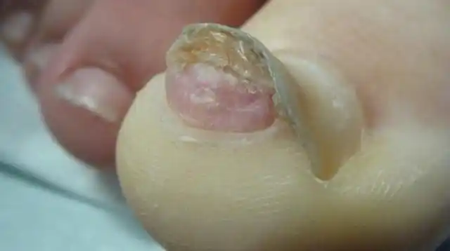 这种毛病千万不要误诊为灰指甲