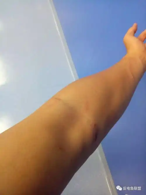 反电鱼志愿者被打手腕粗的棍子被打断派出所说是斗殴绿会关注
