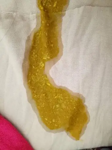 婴儿腹泻的症状 1腹泻轻的小儿大便每天可10次以下,黄绿色,带少量粘液