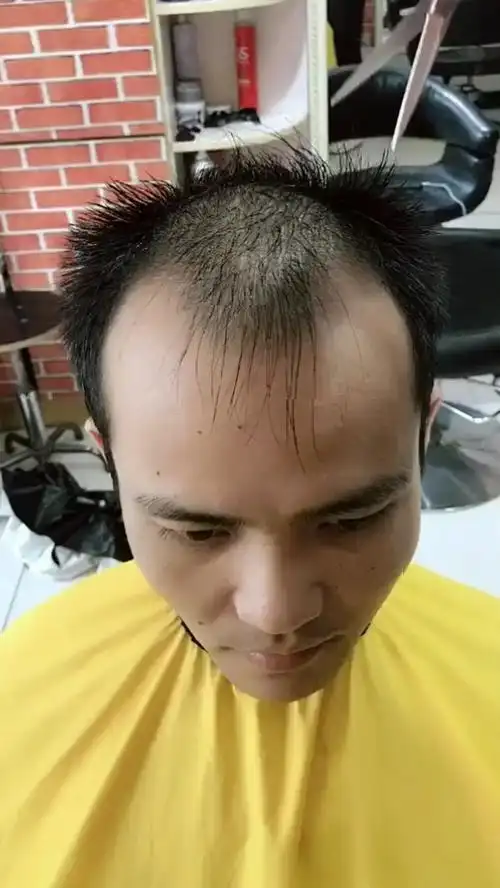 最牛的改变秃顶剪完秒变男神