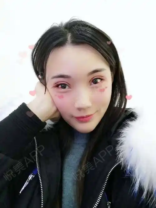 开外眼角术后3天_全切双眼皮术后3天_开眼角术后3天_双眼皮术后3天