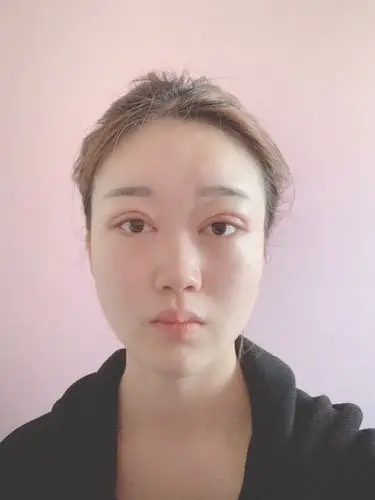 双眼皮术后7天今天来院拆线,双眼皮恢复的很快,现在_圈子-新氧美容