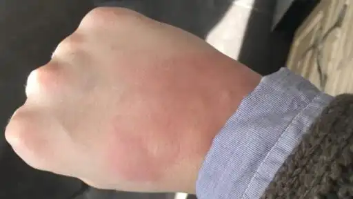 床虱咬过后的疙瘩图片 床虱子的图片大全1cm