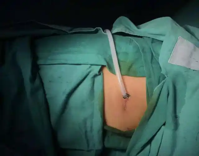 创伤最小的微创胸外科手术--单孔胸腔镜手术