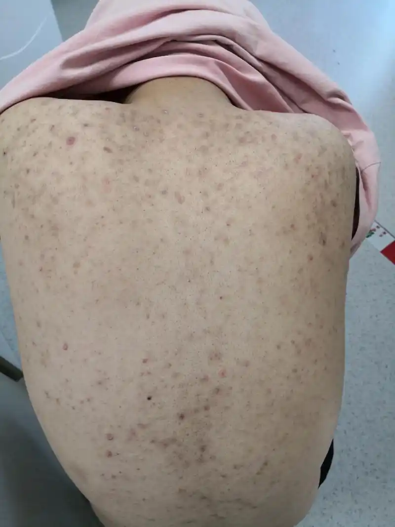 背部毛囊炎症状#解决皮肤问题专注皮肤美容# 细菌性毛囊炎和马拉色菌