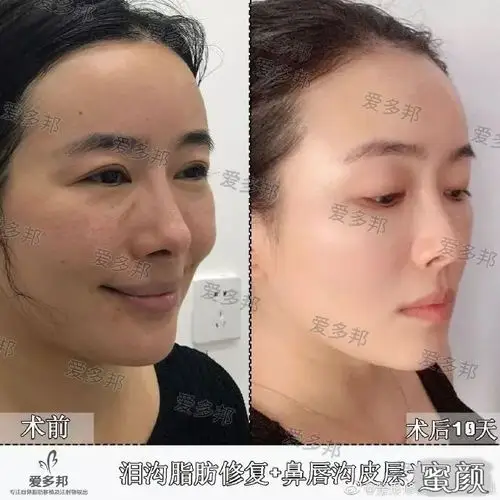 新闻列表 泪沟自体脂肪填充失败修复术后95天效果反馈 案例 反馈