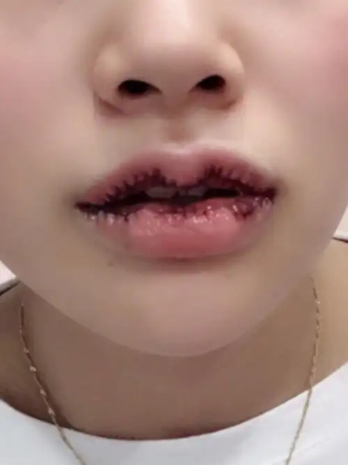 的嘴唇改薄顺带调整了一下m唇嘟嘟嘴,今天刚做完第_圈子-新氧美容整形