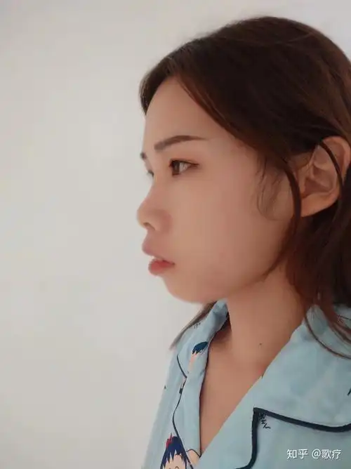 龅牙凸嘴怎么改善侧脸? - 知乎