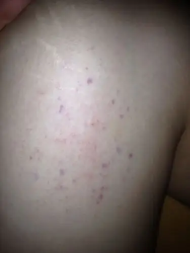 问:膝盖内侧忽然出现一小片紫色斑点,什么情况?不会是紫癜吧?