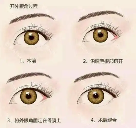 开外眼角一般适用于上下眼睑不能完全闭合的人,改善眼型,此外