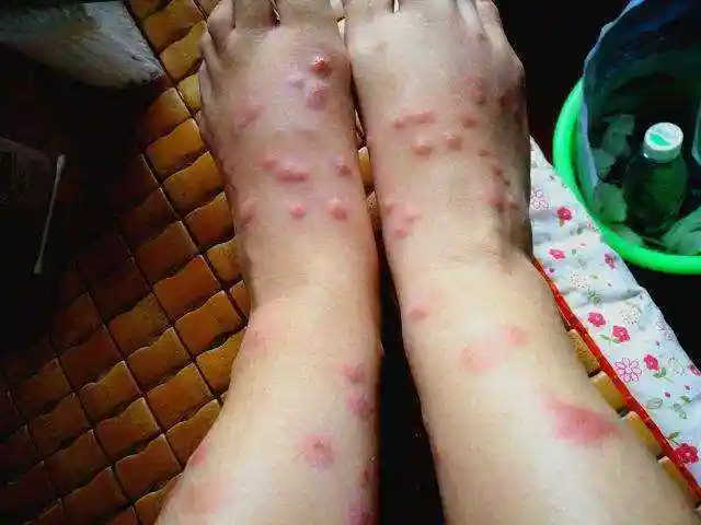 怎样消除被跳蚤咬的包