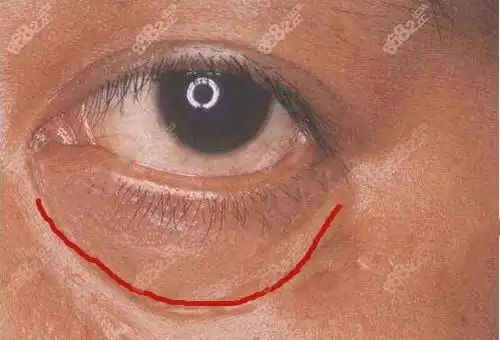 做完眼袋有点外翻不正常来看外切去眼袋下眼睑外翻咋修复