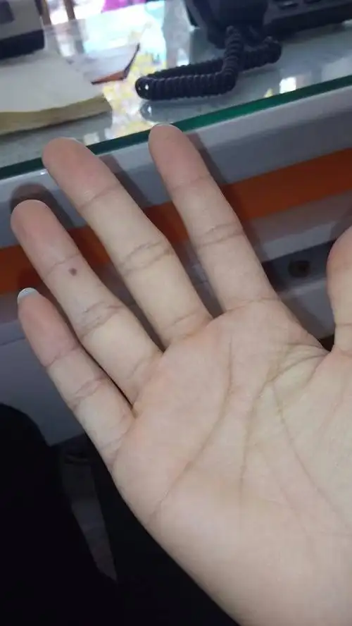 女孩子右手无名指突然长出一棵深褐色的痣,有刺痛的感觉,这是为什么?